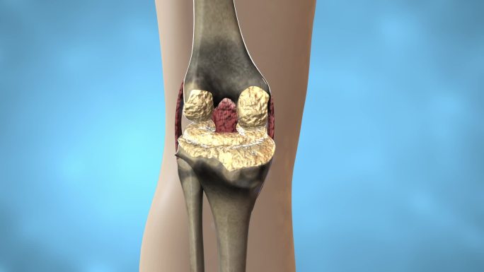 膝关节补钙