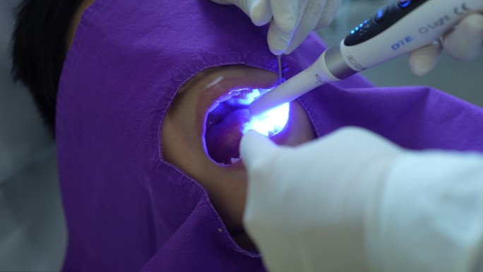 牙医使用紫外线灯对患者进行填充