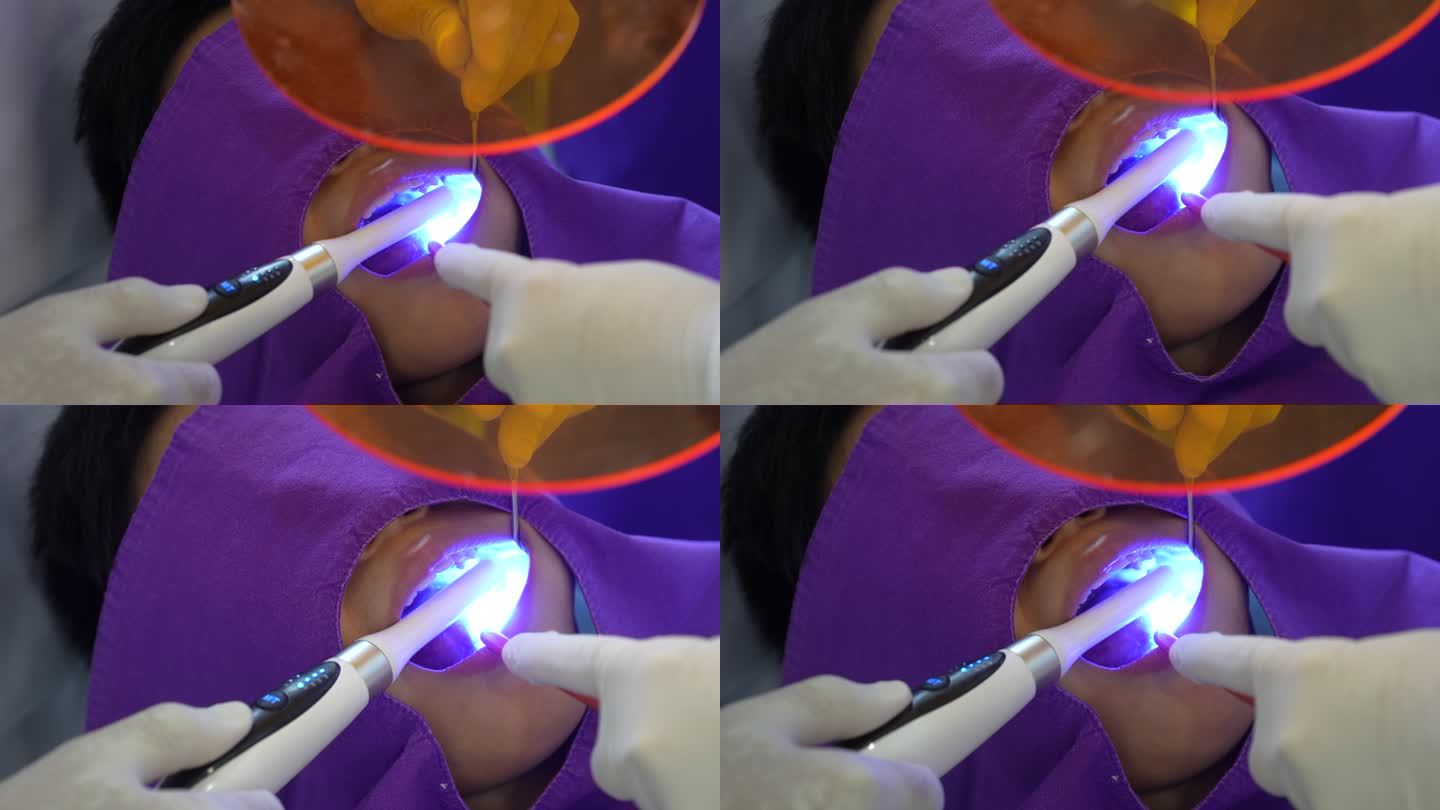 牙医使用紫外线灯对患者进行填充