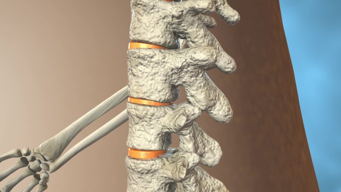 人体脊椎骨质疏松断裂