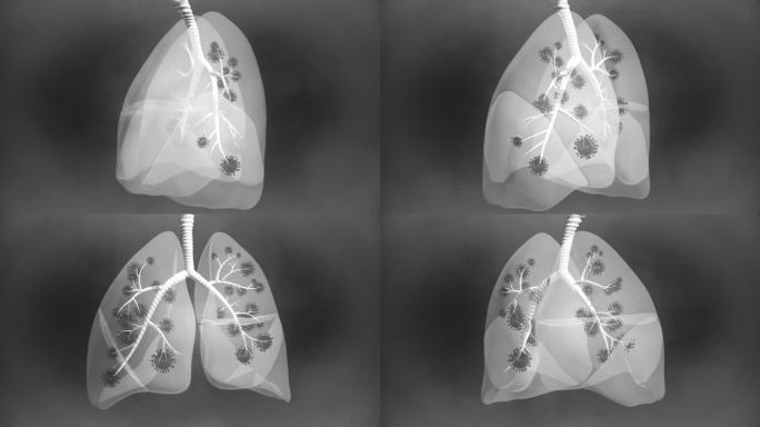 肺部疾病X光透视图-4K分辨率