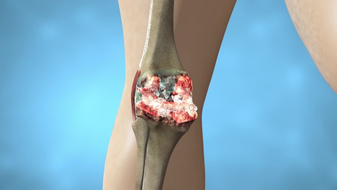 氨糖修复膝关节