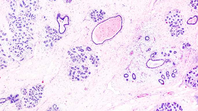 乳腺癌在光学显微镜下不同区域放大