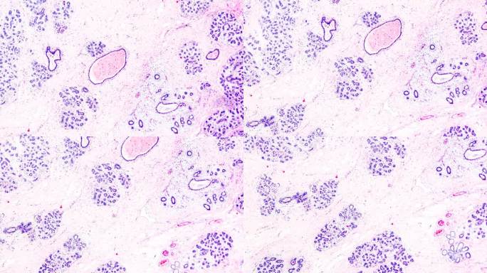 乳腺癌在光学显微镜下不同区域放大