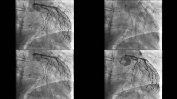 荧光镜记录的冠状动脉造影（X射线电影）