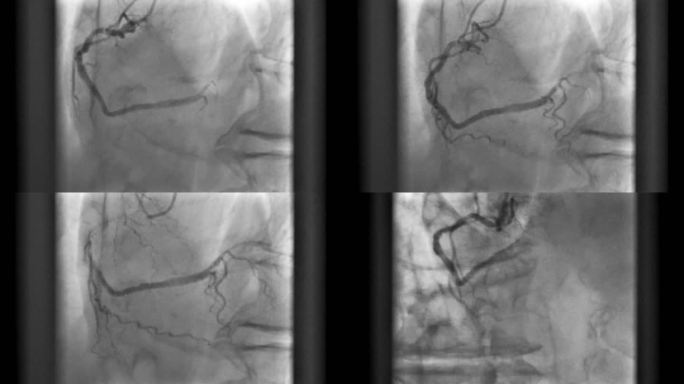 荧光镜记录的冠状动脉造影（X射线电影）