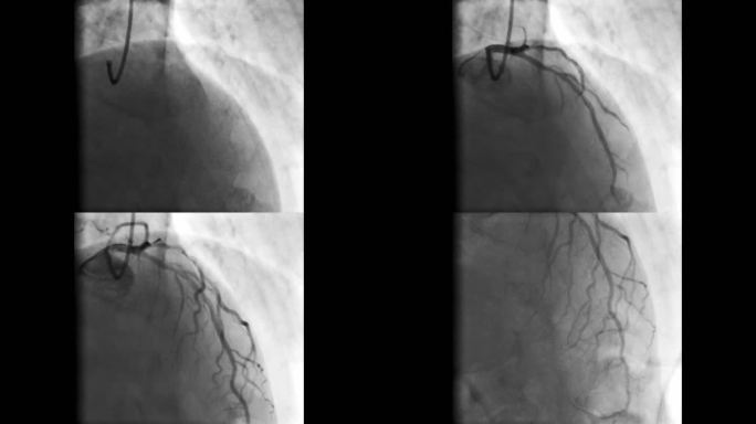 荧光镜记录的冠状动脉造影（X射线电影）