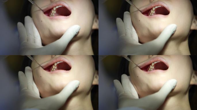 医院医生检查病人口腔牙齿舌头喉咙实拍素材