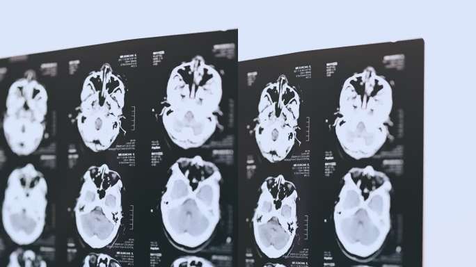 人脑医学扫描胶片人脑医学扫描x光片