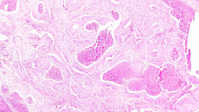 光镜下人肺癌活检光学显微镜乳腺癌细胞