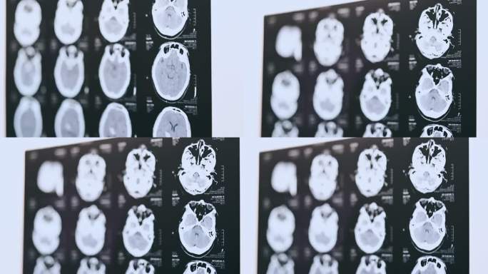 人脑医学扫描胶片脑部CT核磁共振脑部疾病