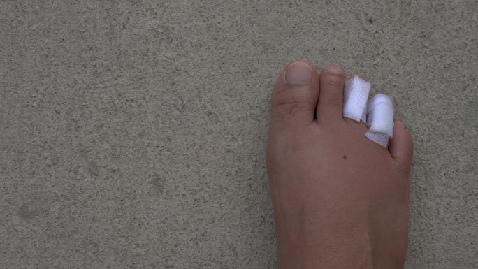 脚趾肿胀和淤青受伤脚趾绷带