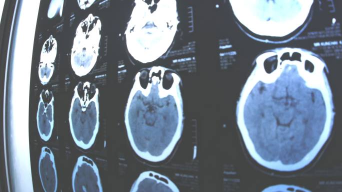 阿尔茨海默病X光片，大脑问题
