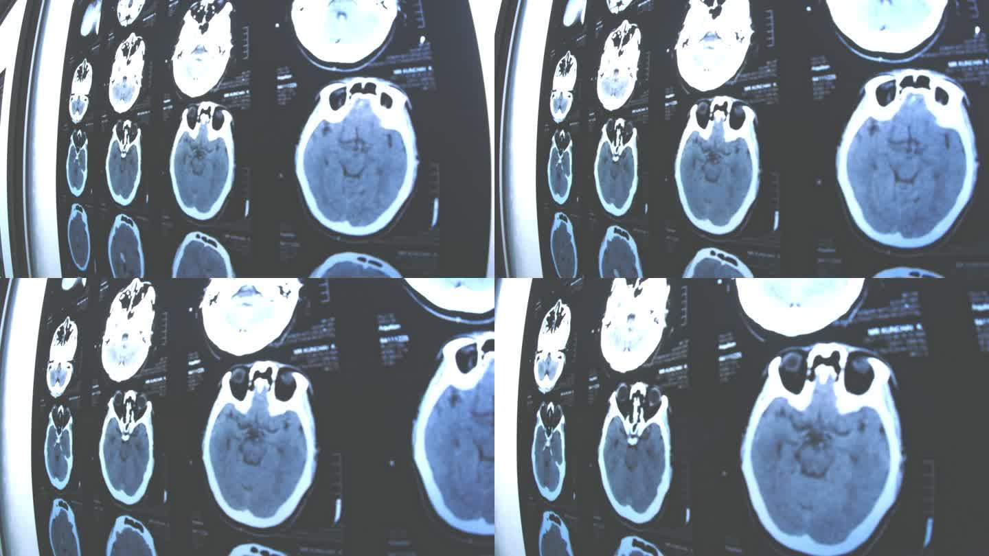 阿尔茨海默病X光片，大脑问题