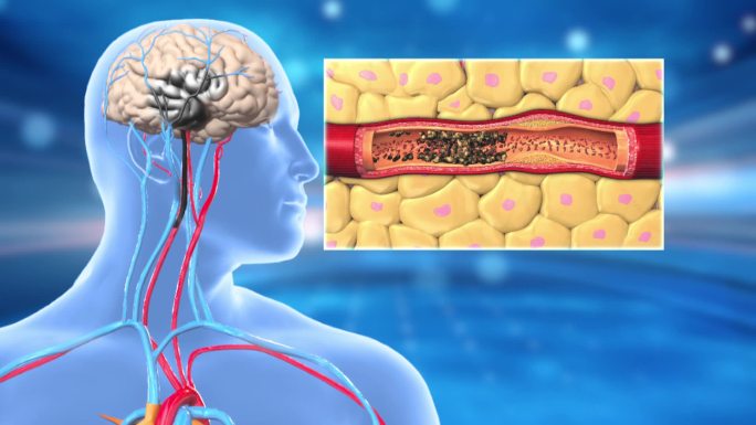 脑梗 脑血管淤堵 脑坏死