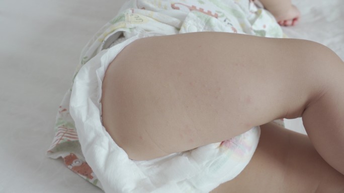 湿疹 红点 疙瘩 宝宝皮肤问题
