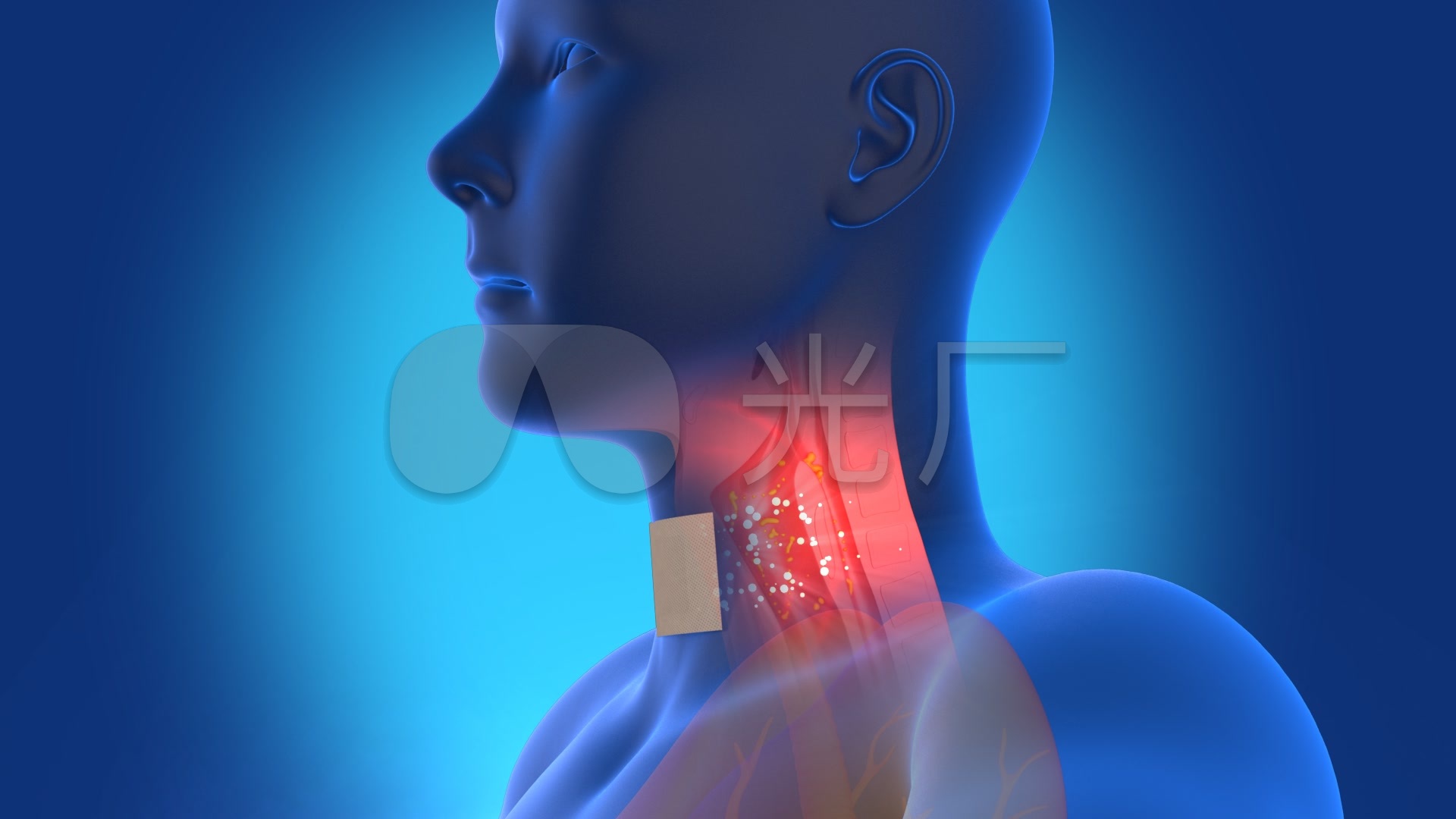 慢性咽炎的病根可能不在嗓子|咽部|鼻腔|食管|-健康界