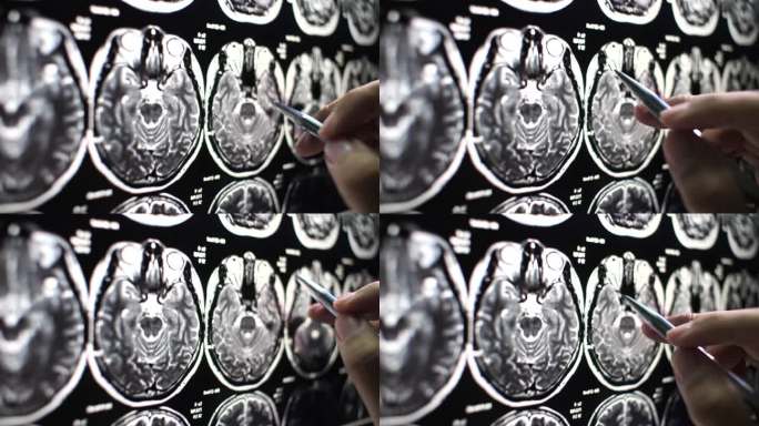 医生检查脑部MRI