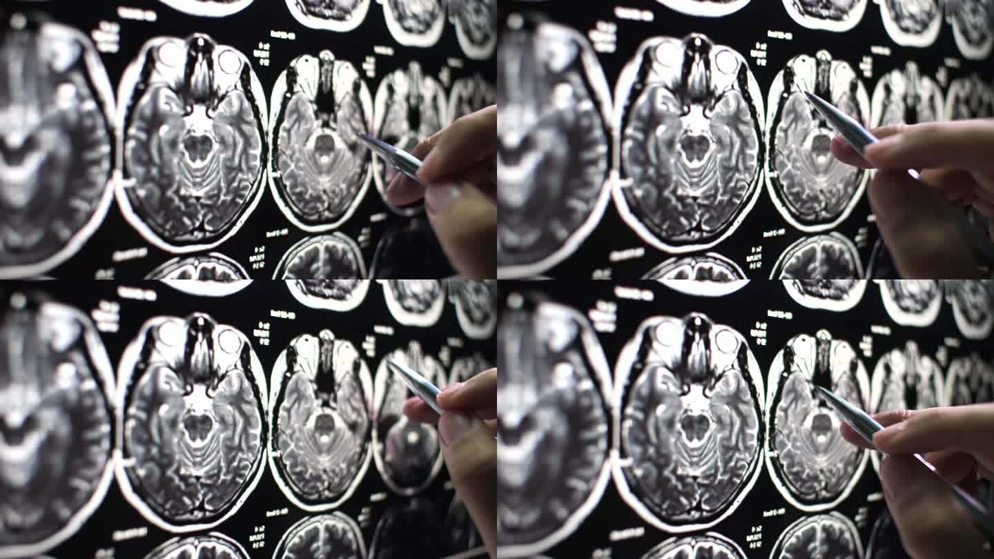 医生检查脑部MRI