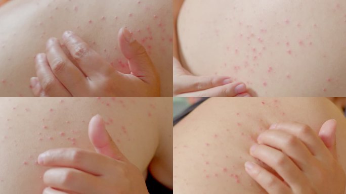 皮肤长痘红肿、湿疹、瘙痒挠痒皮肤过敏