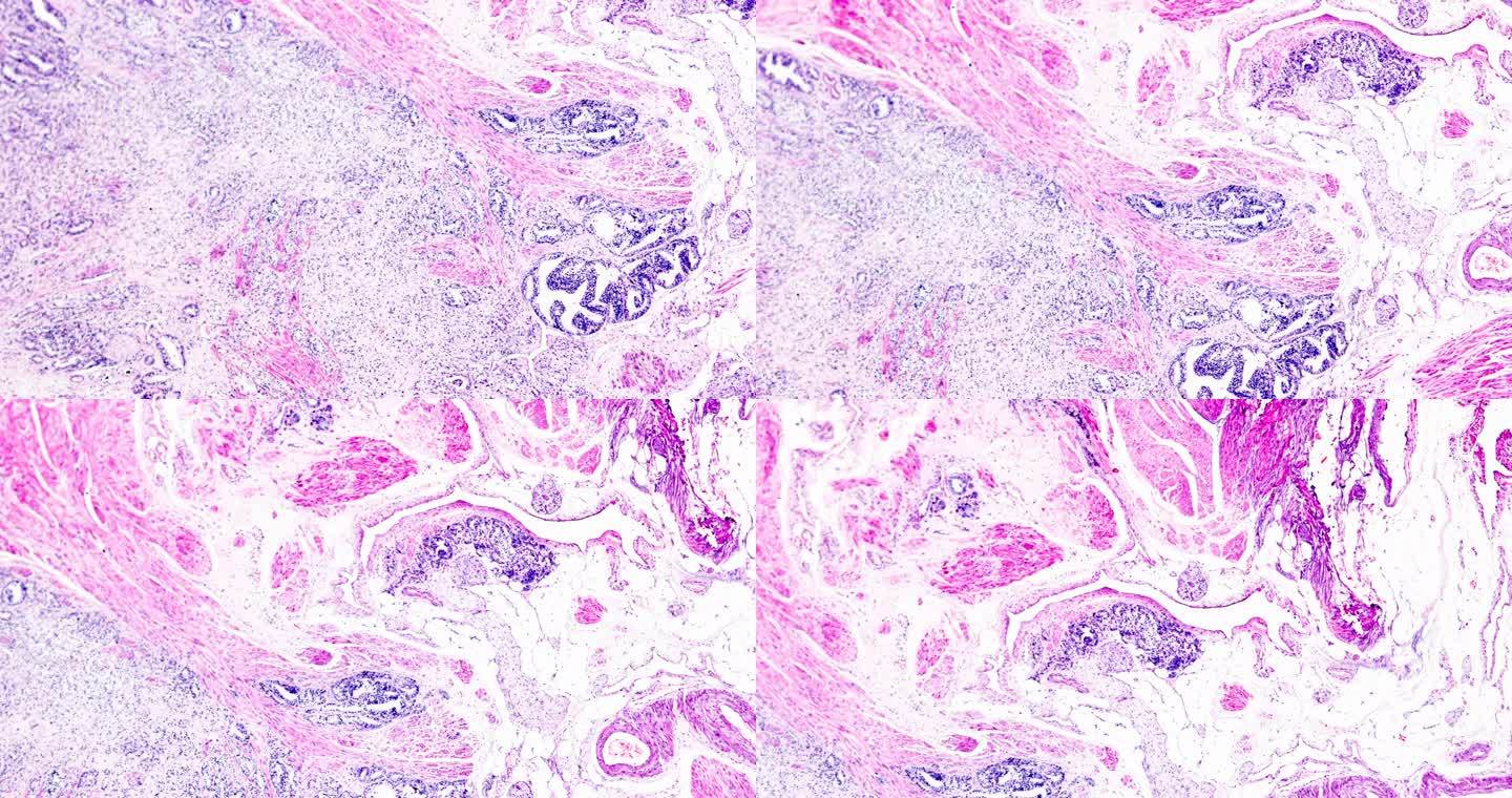 显微镜下前列腺癌活检不同区域放大
