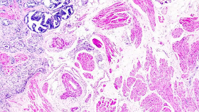 显微镜下前列腺癌活检不同区域放大