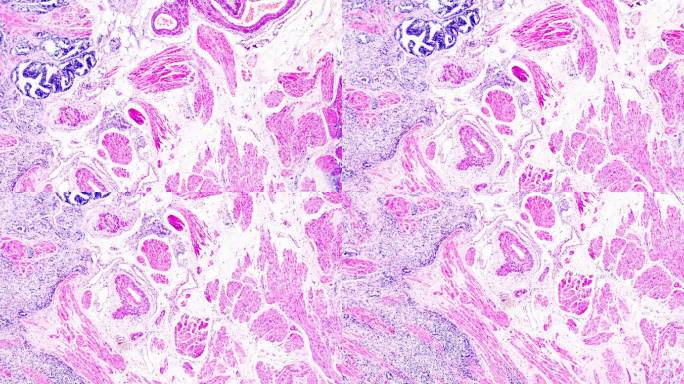 显微镜下前列腺癌活检不同区域放大