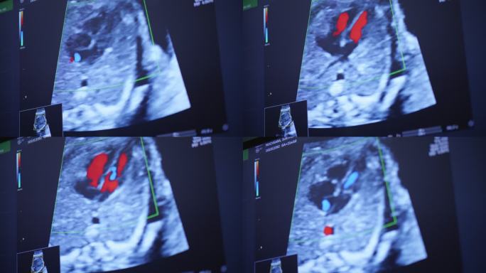 超声扫描妊娠3d和4d超声妊娠胎儿检查人类胚胎胎儿超声检查26周孕中期母体女婴体检