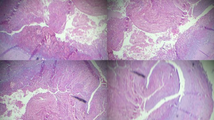 显微镜下血栓人类病理标本