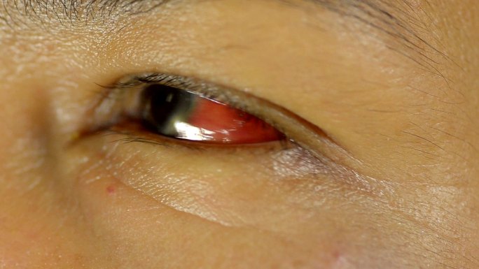 擦伤的眼睛红眼病滴入滴眼液眼镜受伤