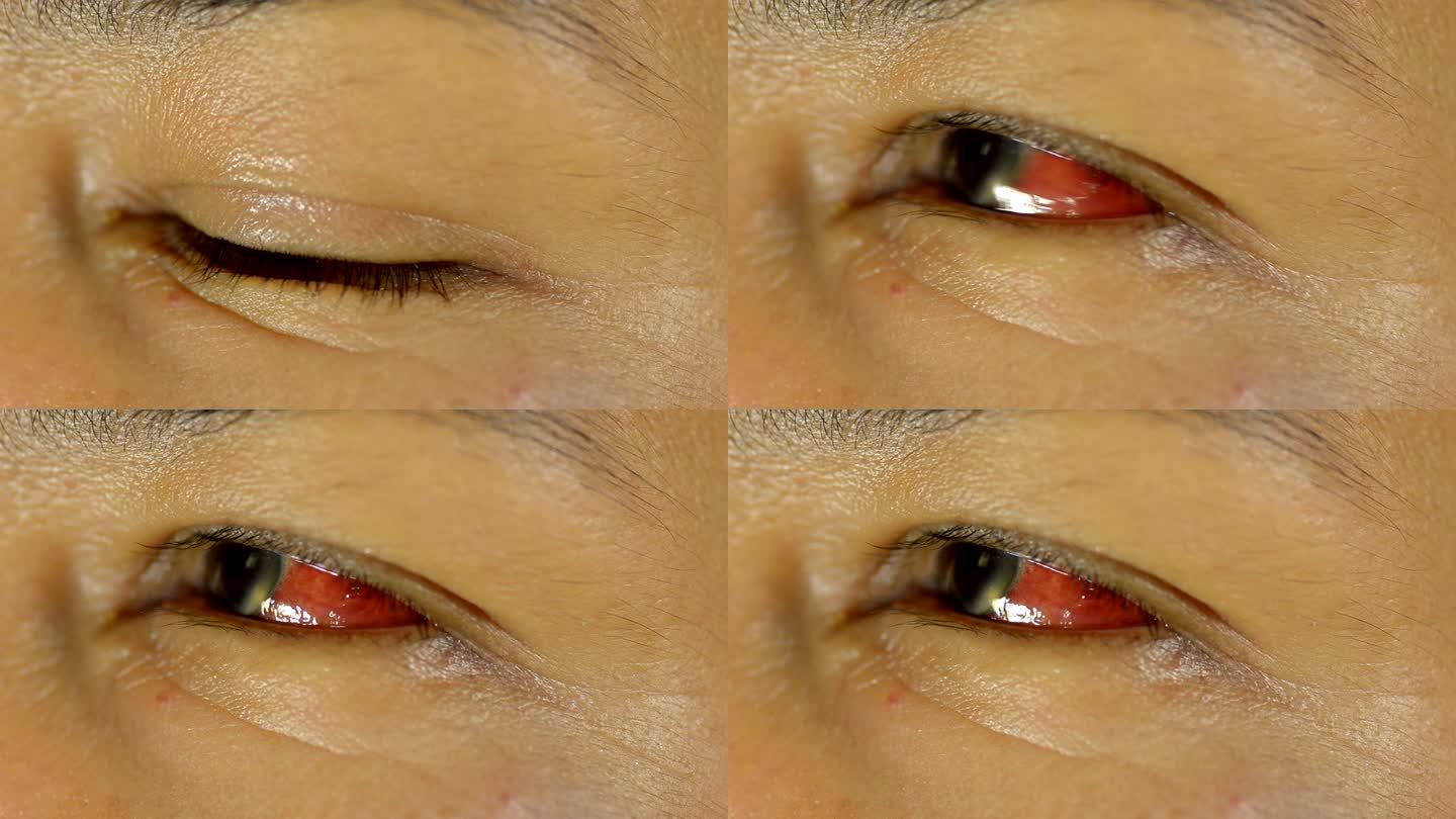 擦伤的眼睛红眼病滴入滴眼液眼镜受伤