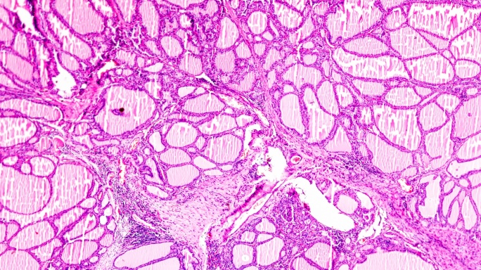 光学显微镜下的毒性甲状腺肿（甲亢）
