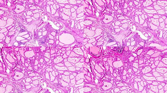 光学显微镜下的毒性甲状腺肿（甲亢）