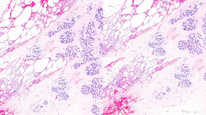 光学显微镜下的乳腺癌在不同区域放大