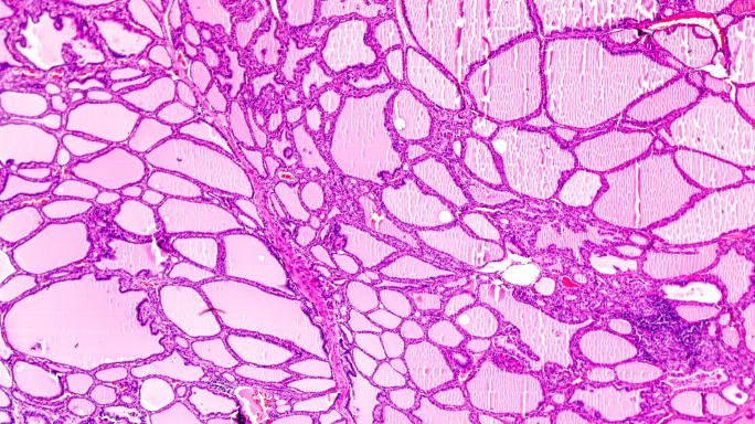 光学显微镜下的毒性甲状腺肿（甲亢）