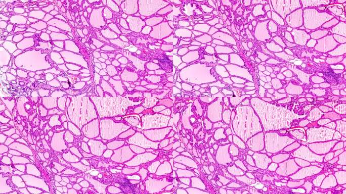 光学显微镜下的毒性甲状腺肿（甲亢）