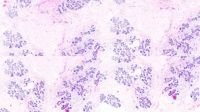 光学显微镜下的乳腺癌在不同区域放大