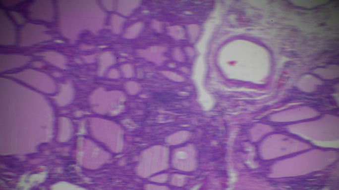 光学显微镜下的毒性甲状腺肿（甲亢）