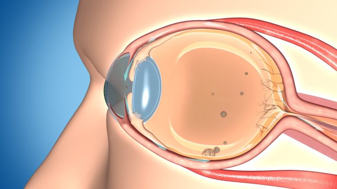 人体眼部 眼病 白内障 玻璃体混浊