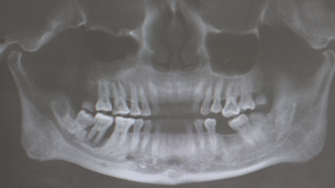 【超清】口腔颌骨CT扫描图