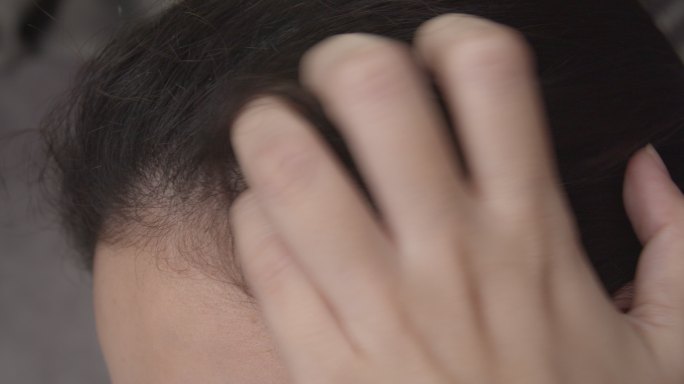 皮肤病，亚洲女人挠头。