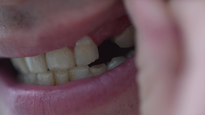 牙龈红肿牙齿断裂缺失豁牙