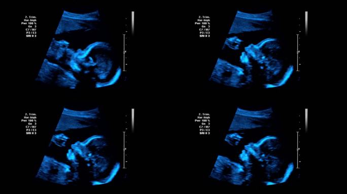 超声波4K超声波b超胎儿检查
