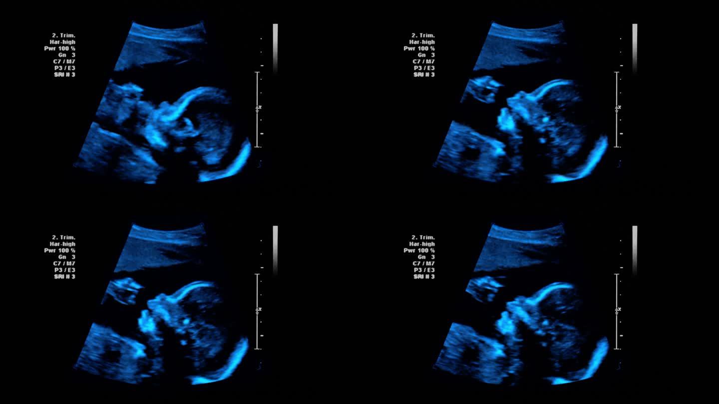 超声波4K超声波b超胎儿检查