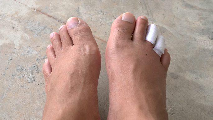 脚趾肿胀和淤青受伤脚趾肿胀