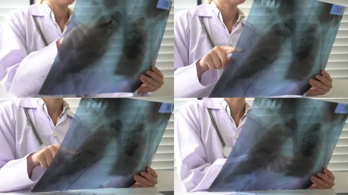 X射线胶片肺炎肺部透视