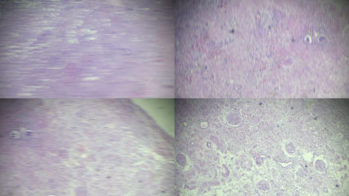 显微镜下的干酪坏死（淋巴、肾脏）人类病理样本