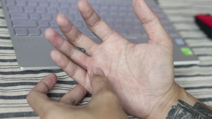 一名亚洲男子感到手发痒，手上有抓痕