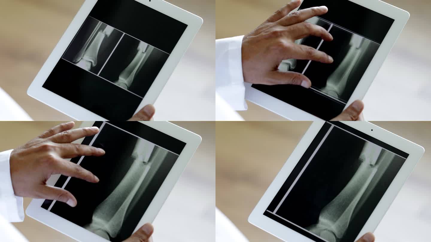 医生使用数字平板电脑进行骨折X光检查