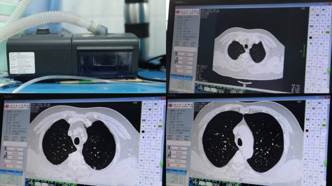 【超清】医生观看-肺部CT